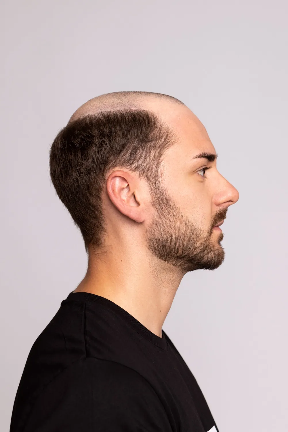 Tim nachher mit Hairify Haarsystem
