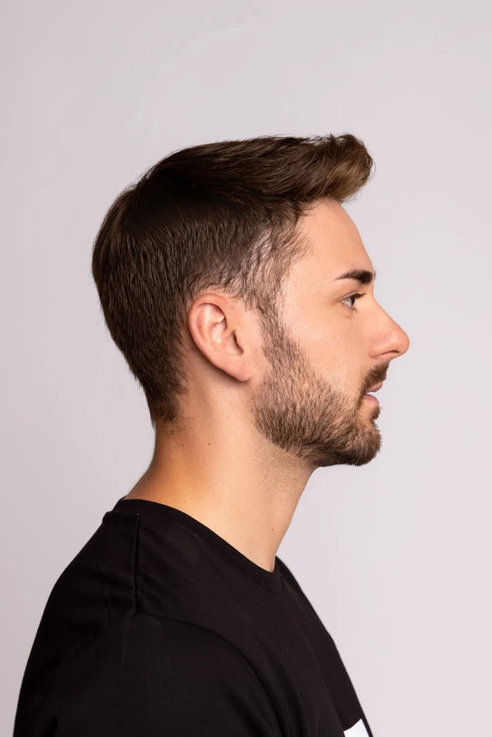 Tim vorher ohne Haarsystem